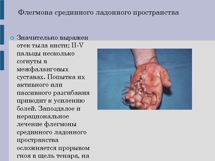 Флегмона срединного ладонного пространства Значительно выражен отек тыла кисти; II-V пальцы несколько согнуты в