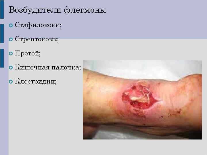 Возбудители флегмоны Стафилококк; Стрептококк; Протей; Кишечная палочка; Клостридии; 