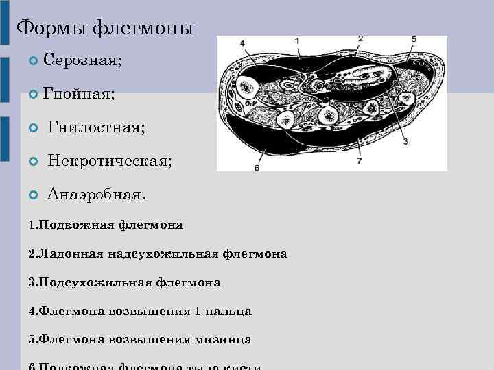 Флегмона стопы карта смп