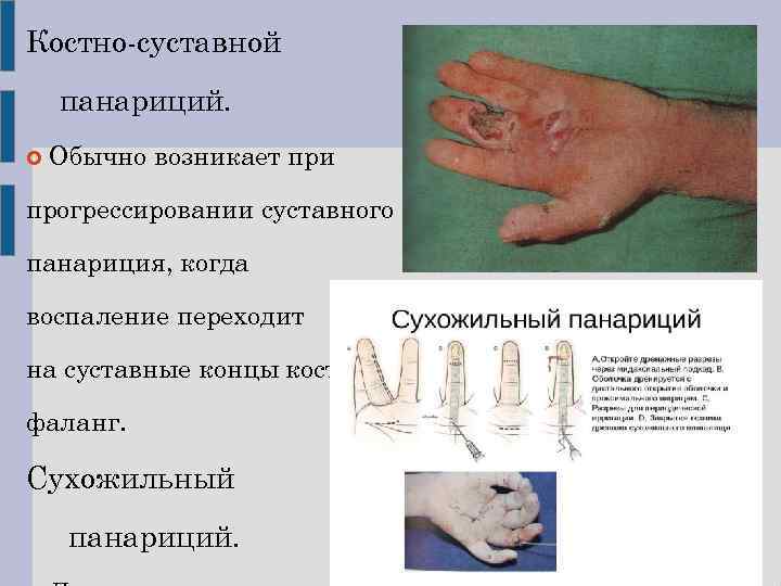 Костно-суставной панариций. Обычно возникает при прогрессировании суставного панариция, когда воспаление переходит на суставные концы