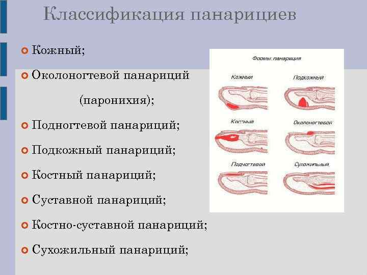 Классификация панарициев Кожный; Околоногтевой панариций (паронихия); Подногтевой панариций; Подкожный панариций; Костный панариций; Суставной панариций;