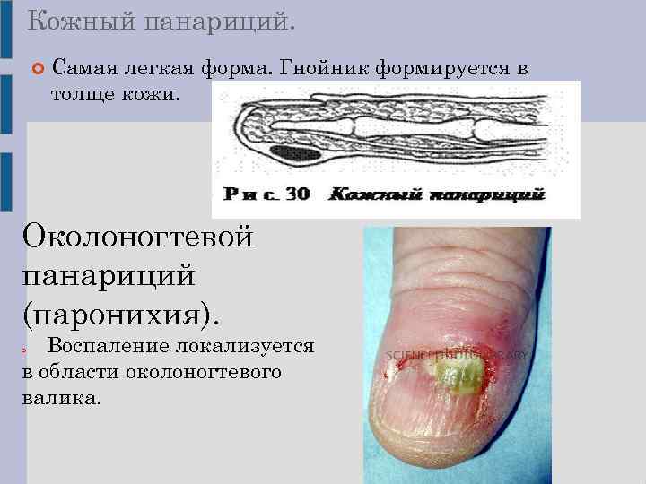 Кожный панариций. Самая легкая форма. Гнойник формируется в толще кожи. Околоногтевой панариций (паронихия). Воспаление