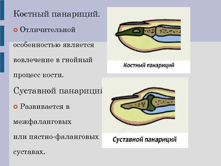 Панариций виды. Первичный костный панариций. Панариций дистальной фаланги. Подкожный панариций концевой фаланги.