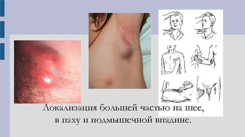 Локализация большей частью на шее, в паху и подмышечной впадине. 