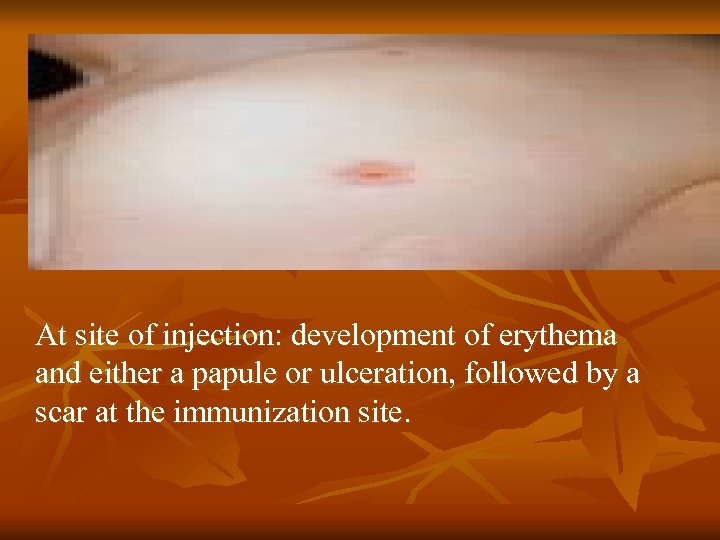 At site of injection: development of erythema and either a papule or ulceration, followed