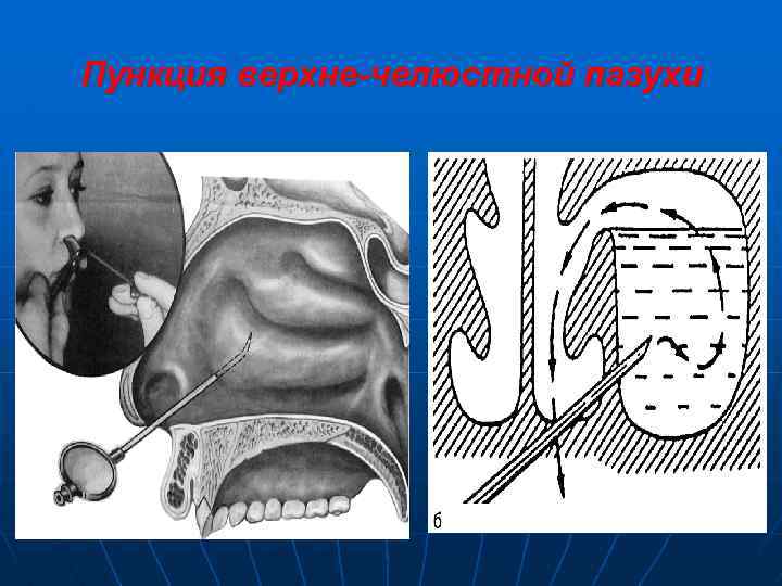 Пункция верхне-челюстной пазухи 