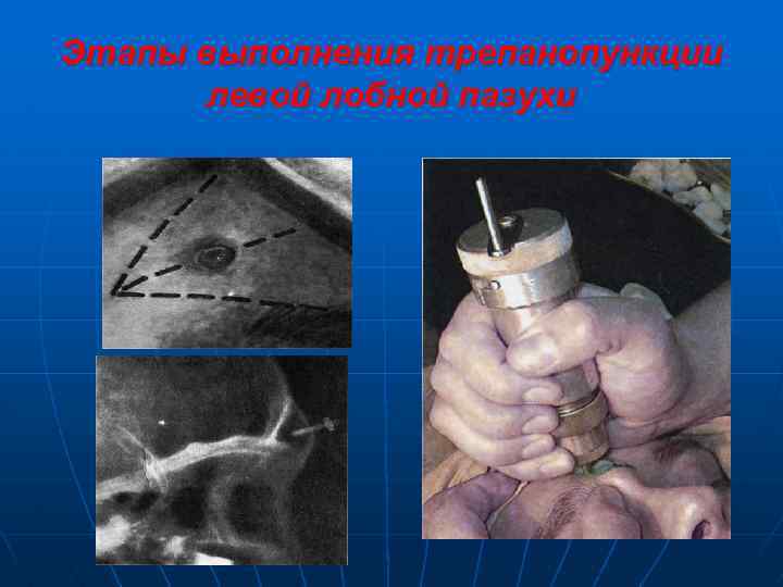 Этапы выполнения трепанопункции левой лобной пазухи 