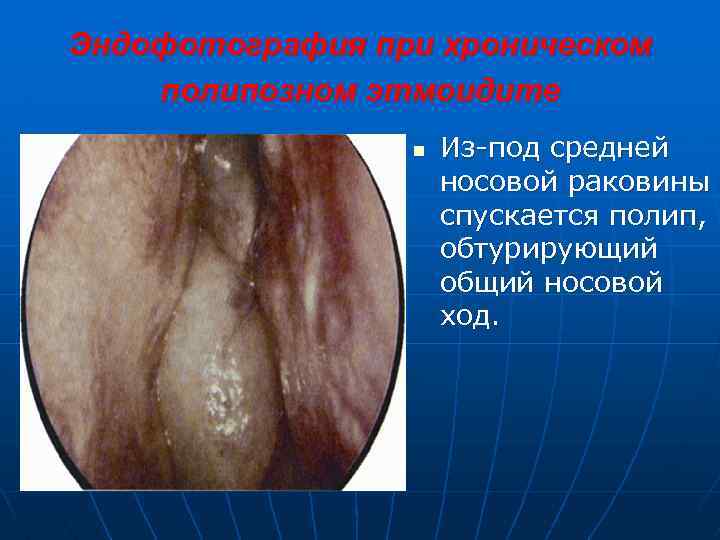 Эндофотография при хроническом полипозном этмоидите n Из-под средней носовой раковины спускается полип, обтурирующий общий