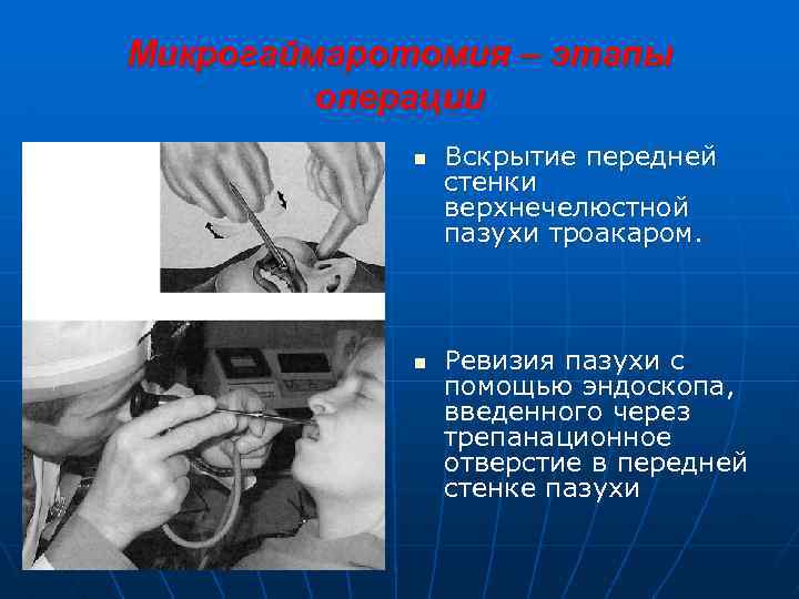 Микрогаймаротомия – этапы операции n n Вскрытие передней стенки верхнечелюстной пазухи троакаром. Ревизия пазухи