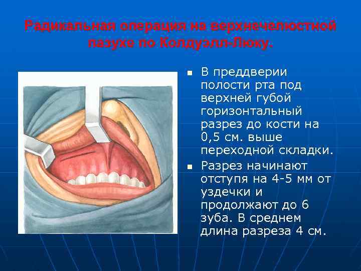 Радикальная операция на верхнечелюстной пазухе по Колдуэлл-Люку. n n В преддверии полости рта под