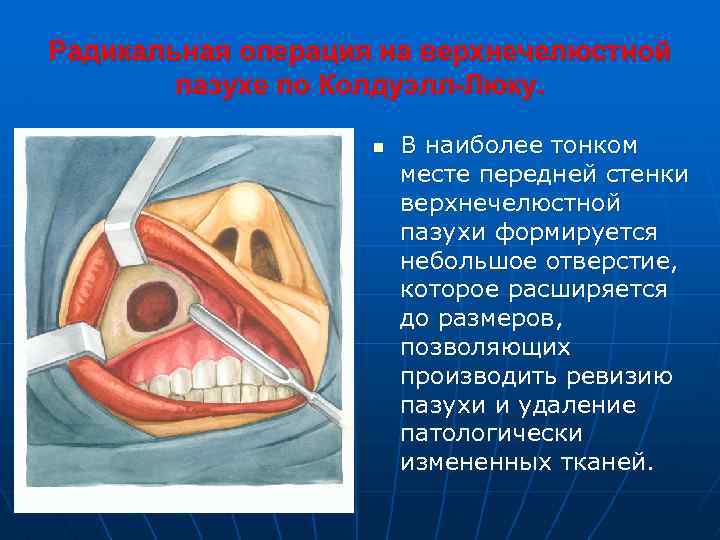 Радикальная операция на верхнечелюстной пазухе по Колдуэлл-Люку. n В наиболее тонком месте передней стенки