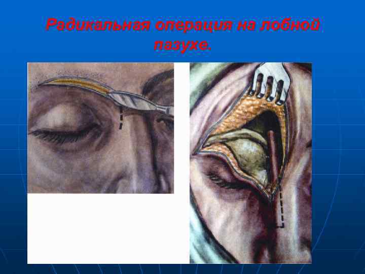 Радикальная операция на лобной пазухе. 