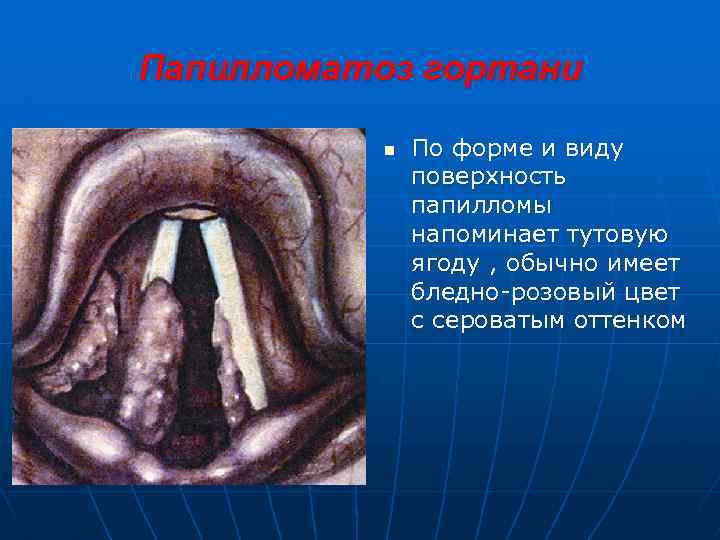 Папилломатоз гортани n По форме и виду поверхность папилломы напоминает тутовую ягоду , обычно