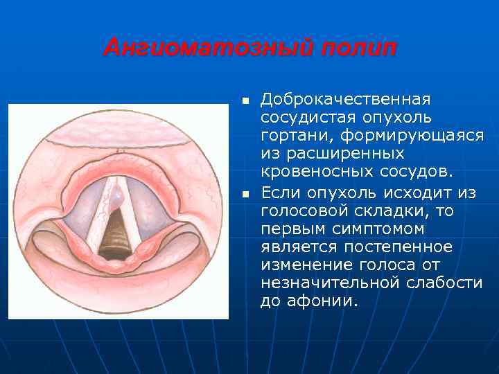 Ангиоматозный полип n n Доброкачественная сосудистая опухоль гортани, формирующаяся из расширенных кровеносных сосудов. Если