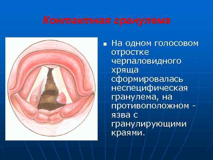 Контактная гранулема n На одном голосовом отростке черпаловидного хряща сформировалась неспецифическая гранулема, на противоположном