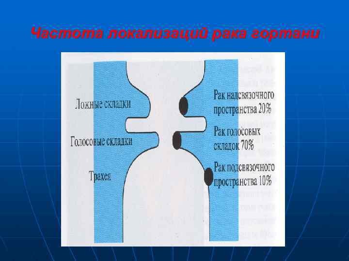 Частота локализаций рака гортани 