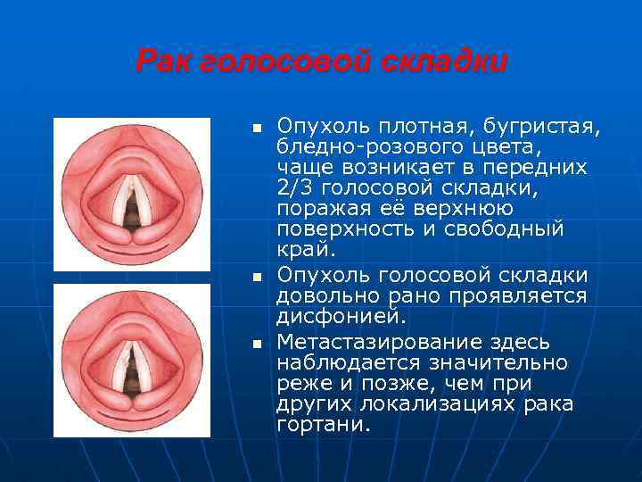Рак голосовой складки n n n Опухоль плотная, бугристая, бледно-розового цвета, чаще возникает в