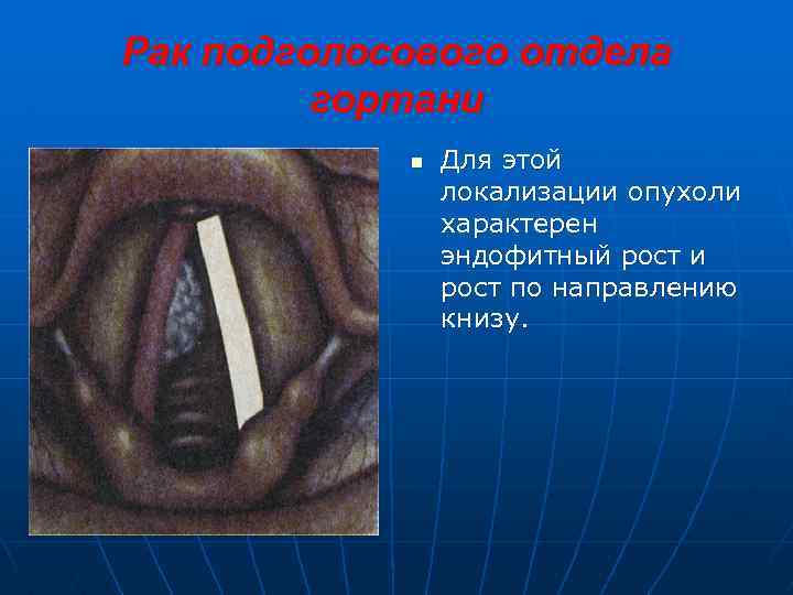 Рак подголосового отдела гортани n Для этой локализации опухоли характерен эндофитный рост и рост