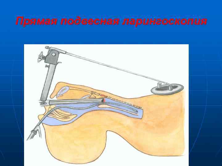 Прямая подвесная ларингоскопия 