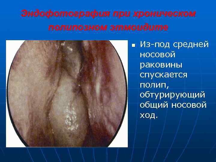 Эндофотография при хроническом полипозном этмоидите n Из-под средней носовой раковины спускается полип, обтурирующий общий
