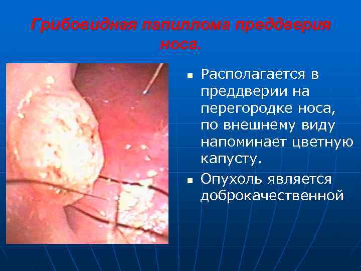 Грибовидная папиллома преддверия носа. n n Располагается в преддверии на перегородке носа, по внешнему