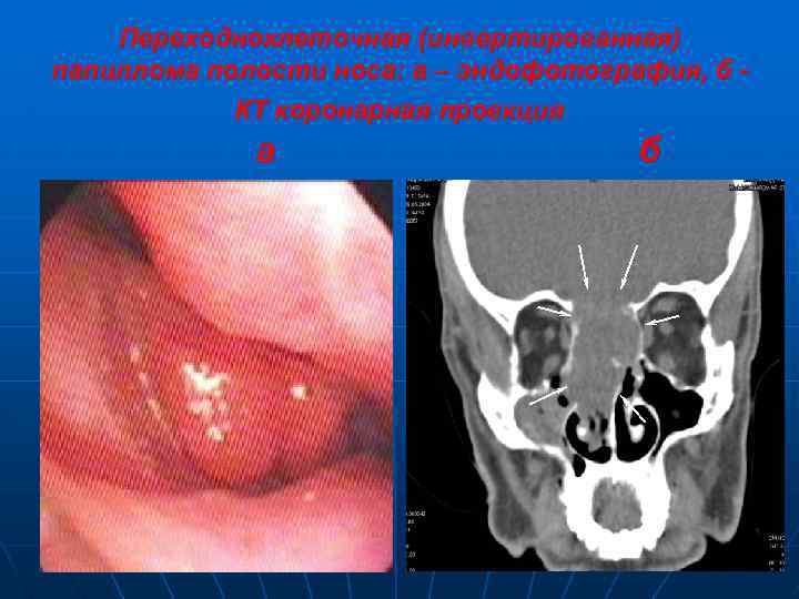 Переходноклеточная (инвертированная) папиллома полости носа: а – эндофотография, б КТ коронарная проекция а б