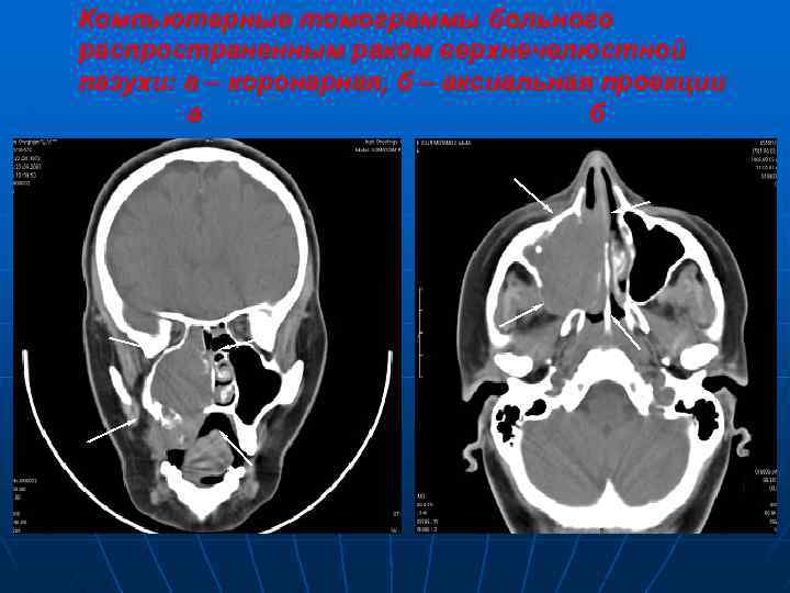 Компьютерные томограммы больного распространенным раком верхнечелюстной пазухи: а – коронарная, б – аксиальная проекции