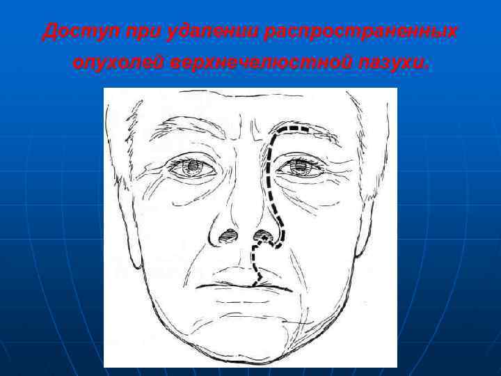 Доступ при удалении распространенных опухолей верхнечелюстной пазухи. 