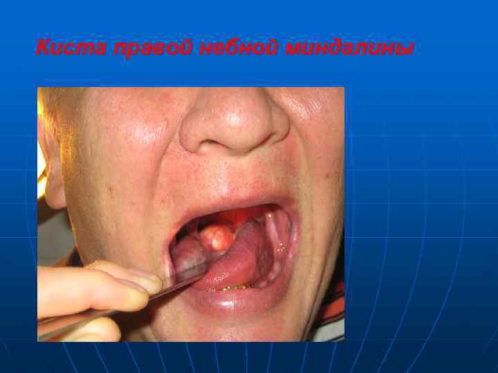 Киста правой небной миндалины 