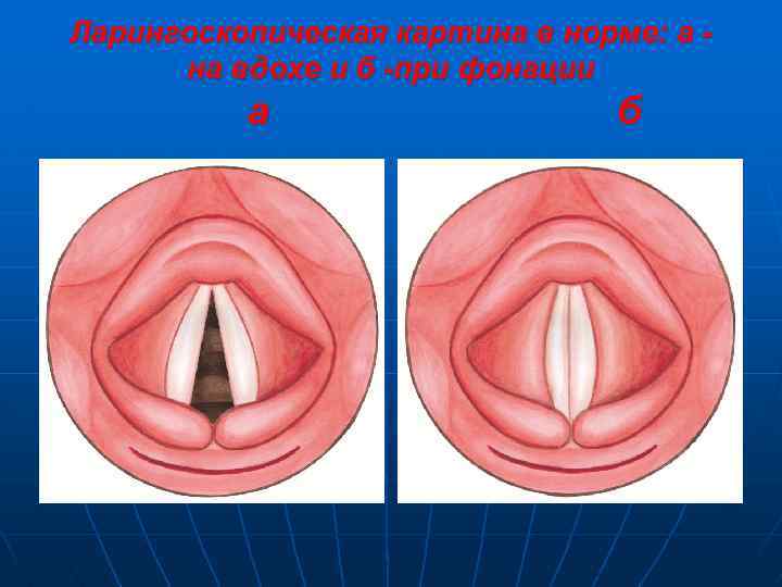 Ларингоскопическая картина в норме: а на вдохе и б -при фонации а б 