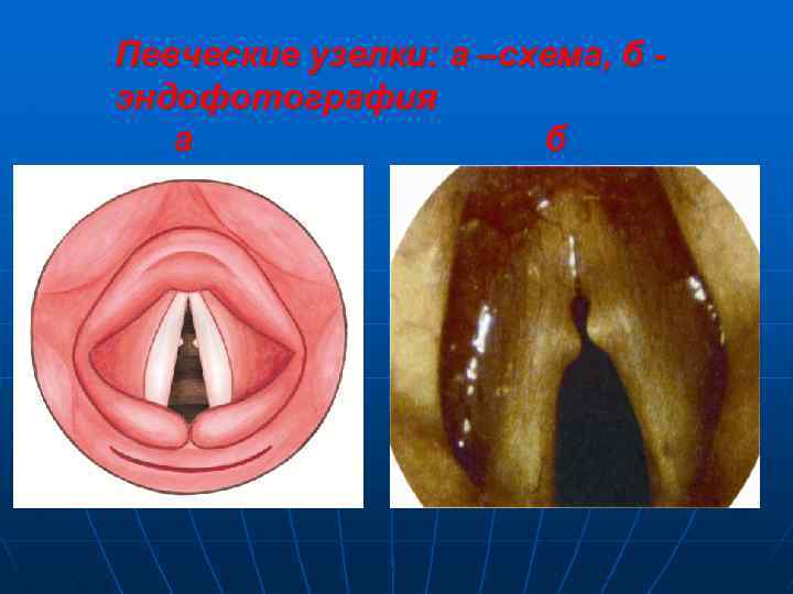 Певческие узелки: а –схема, б эндофотография а б 