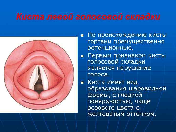 Киста левой голосовой складки n n n По происхождению кисты гортани премущественно ретенционные. Первым