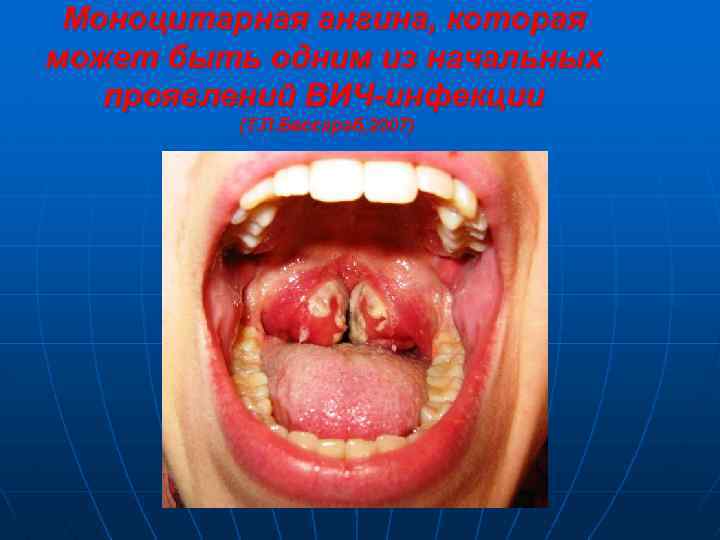 Моноцитарная ангина, которая может быть одним из начальных проявлений ВИЧ-инфекции (Т. П. Бессараб, 2007)