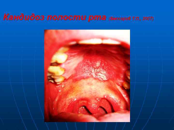 Кандидоз полости рта (Бессараб Т. П. , 2007) 
