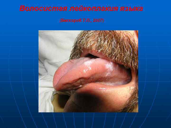 Волосистая лейкоплакия языка (Бессараб Т. П. , 2007) 