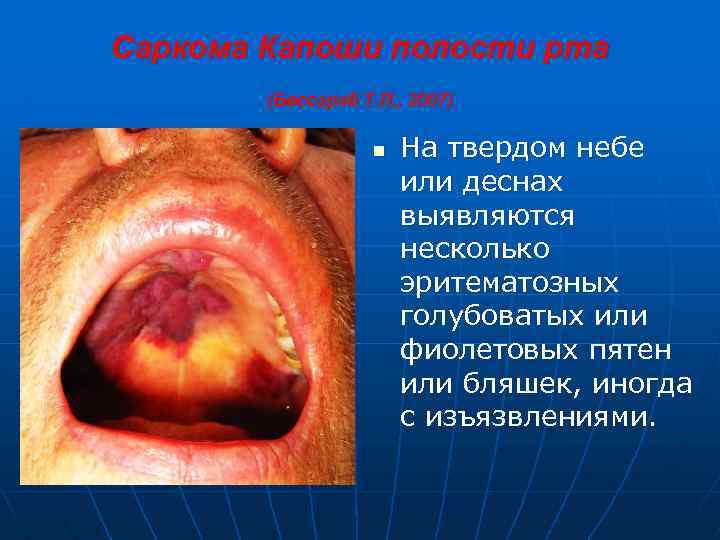 Саркома Капоши полости рта (Бессараб Т. П. , 2007) n На твердом небе или