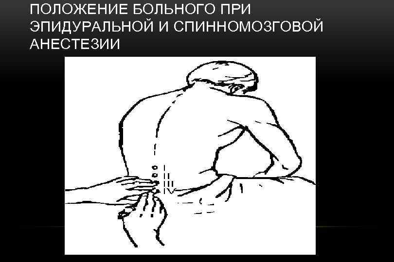ПОЛОЖЕНИЕ БОЛЬНОГО ПРИ ЭПИДУРАЛЬНОЙ И СПИННОМОЗГОВОЙ АНЕСТЕЗИИ 