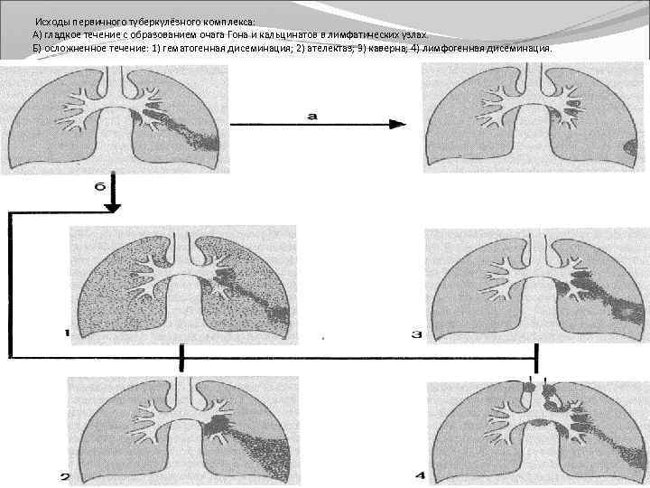  Исходы первичного туберкулёзного комплекса: А) гладкое течение с образованием очага Гона и кальцинатов
