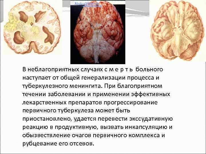 В неблагоприятных случаях с м е р т ь больного наступает от общей генерализации