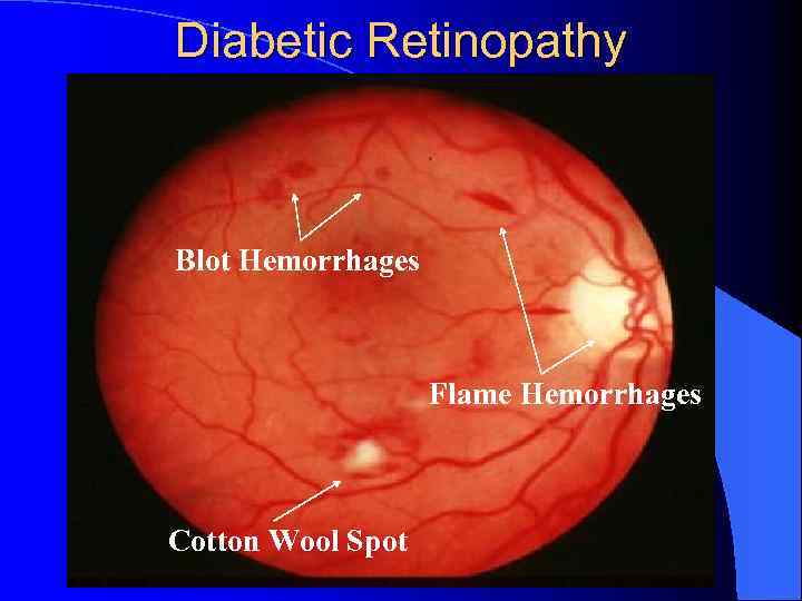Diabetic Retinopathy Blot Hemorrhages Flame Hemorrhages Cotton Wool Spot 