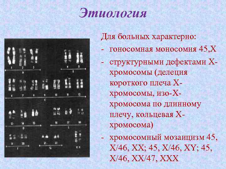 Кариотип характерен для. Моносомия по х-хромосоме кариотип. Мозаичная форма моносомии по хромосоме х. Делеция хромосомы. Моносомия по 1 хромосоме.