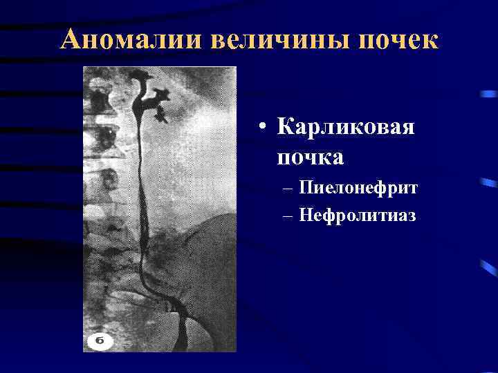 Аномалии величины почек • Карликовая почка – Пиелонефрит – Нефролитиаз 