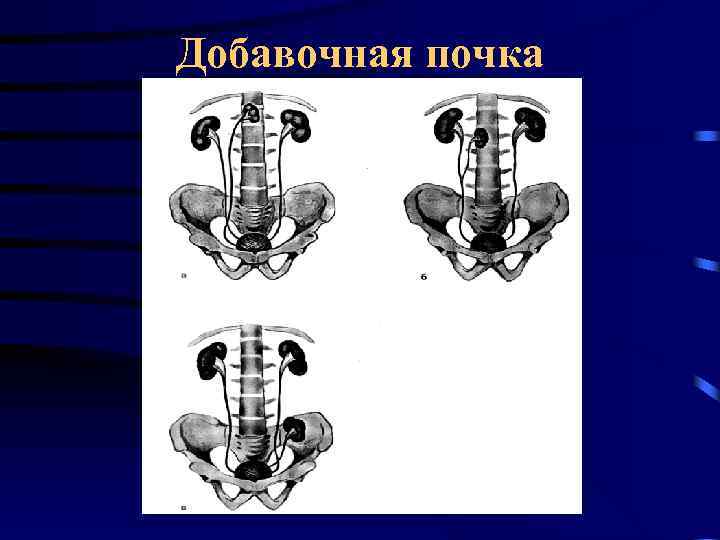 Добавочная почка 