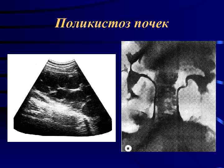 Поликистоз почек 