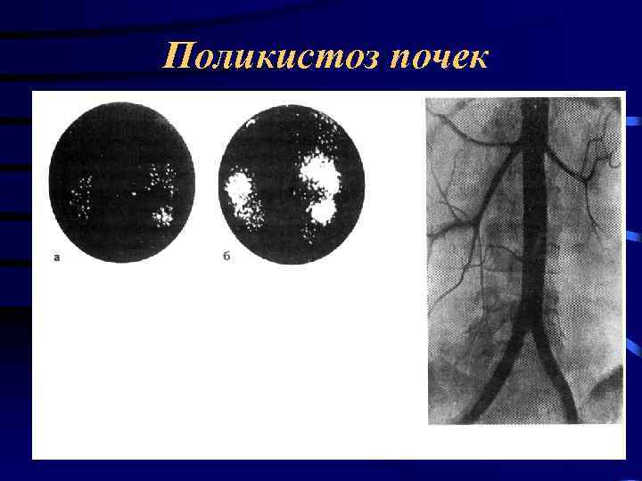 Поликистоз почек 