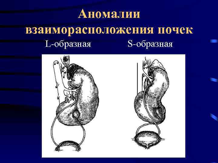 Аномалии взаиморасположения почек L-образная S-образная 