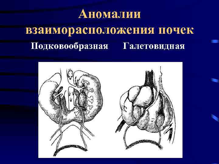 Аномалии взаиморасположения почек Подковообразная Галетовидная 