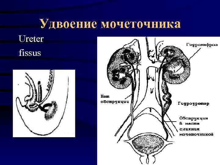 Удвоение мочеточника Ureter fissus 