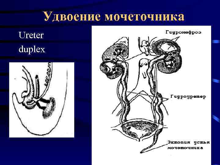 Удвоение мочеточника Ureter duplex 