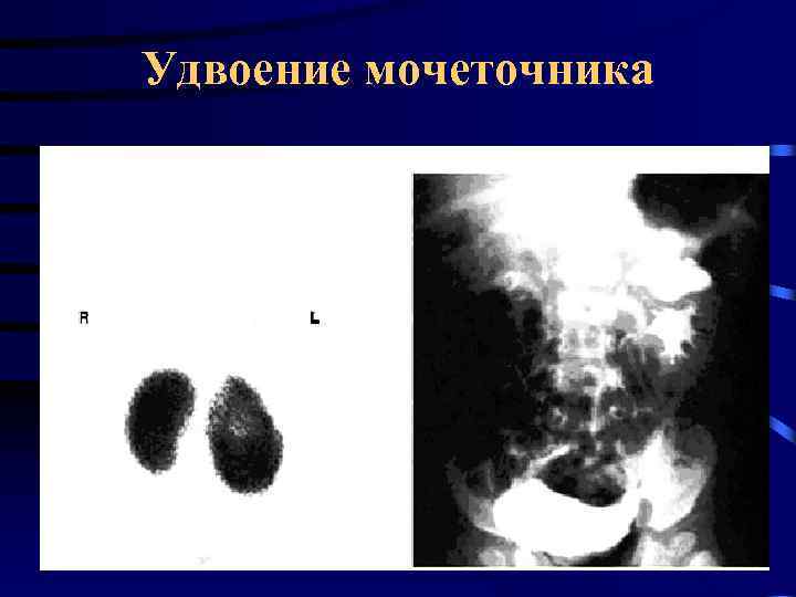 Удвоение мочеточника 